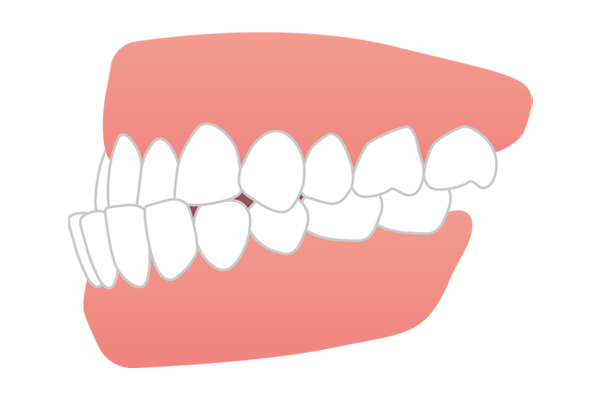 受け口・しゃくれの歯並びイメージ図