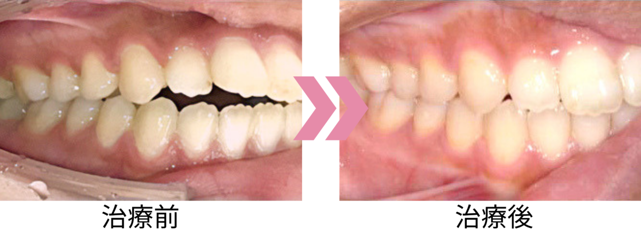 上顎前突の治療前後の比較写真