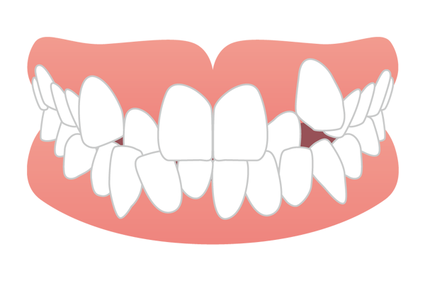 八重歯の歯並びイメージ図