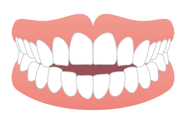 開咬の歯並びイメージ図