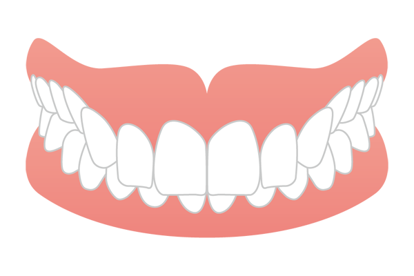 過蓋咬合の歯並びイメージ図
