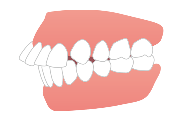 出っ歯の歯並びイメージ図
