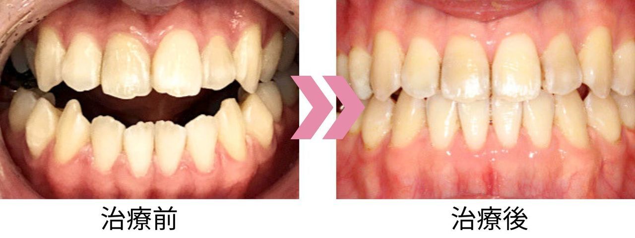 下顎前突と開口の治療前後の比較写真