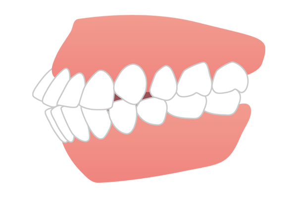 口ゴボの歯並びイメージ図