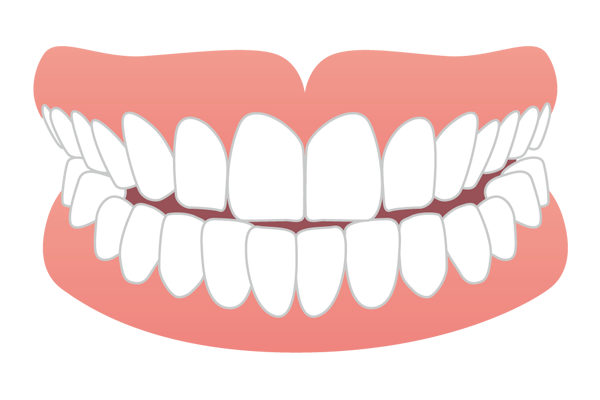 切端咬合の歯並びイメージ図