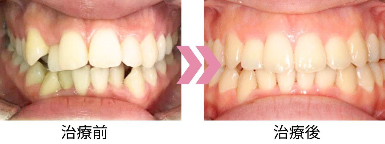 叢生と開咬の治療前後の比較写真